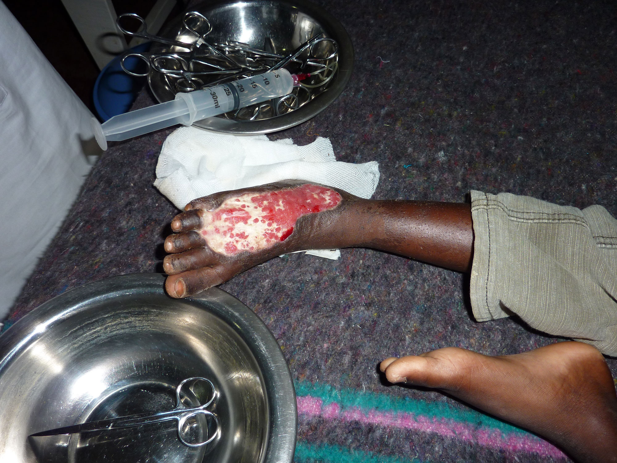 Travel Medicine - Treatment for a Puff Adder Snake Bite