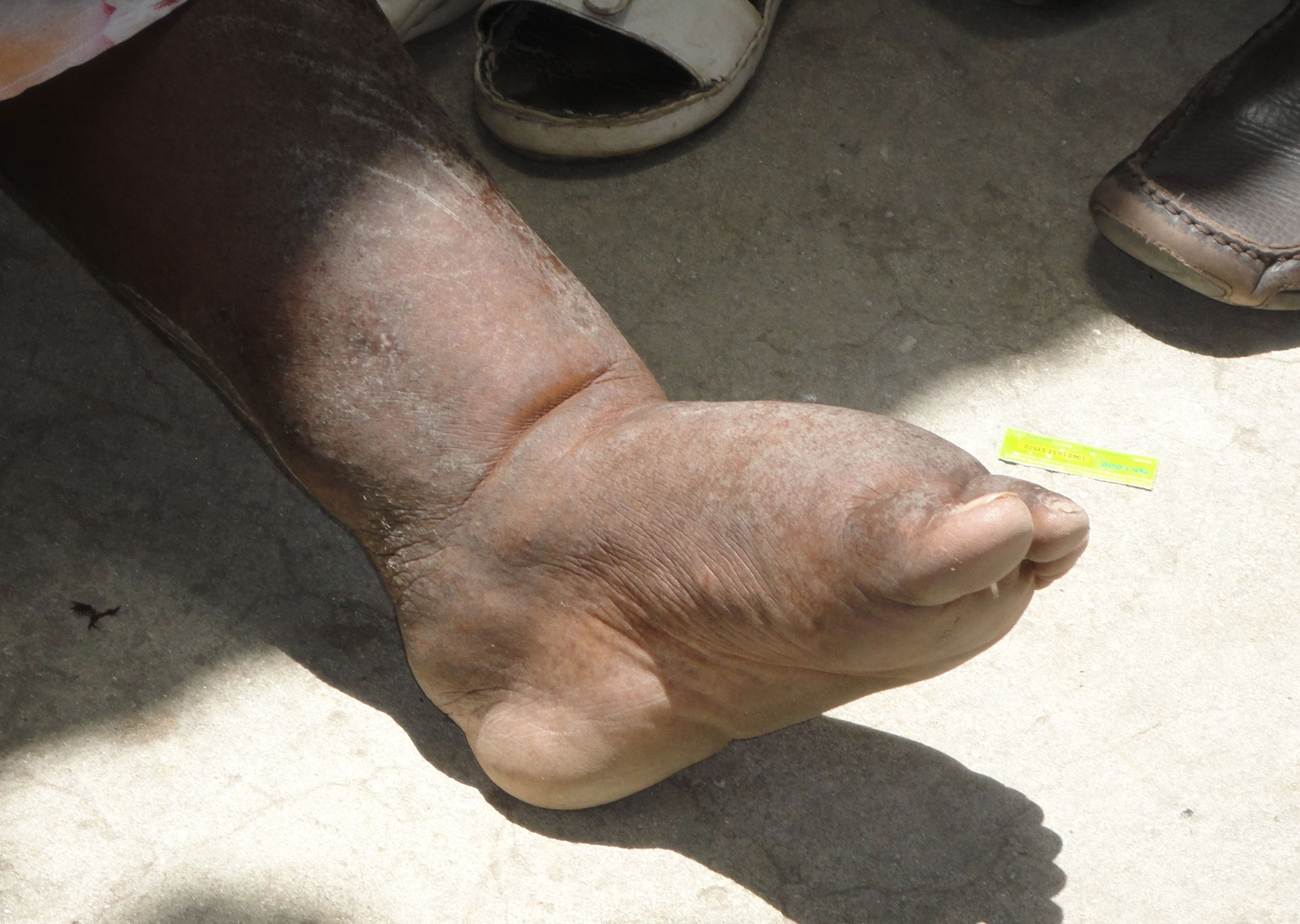Travel Medicine - Lymphatic Filariasis