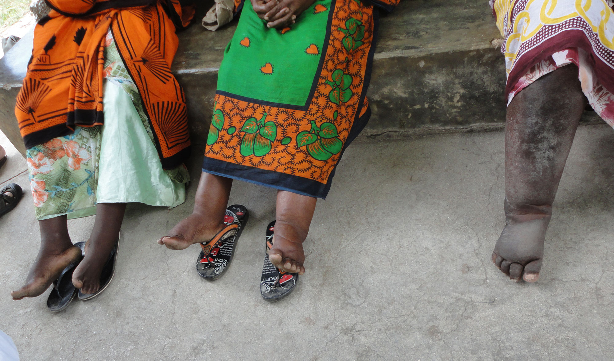 Travel Medicine - Lymphatic Filariasis